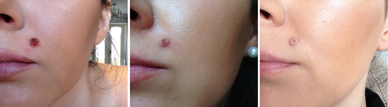 bradavicecharlotte-in-england-blog-How to Remove a Mole with Apple Cider Vinegar (ACV) at Home-03