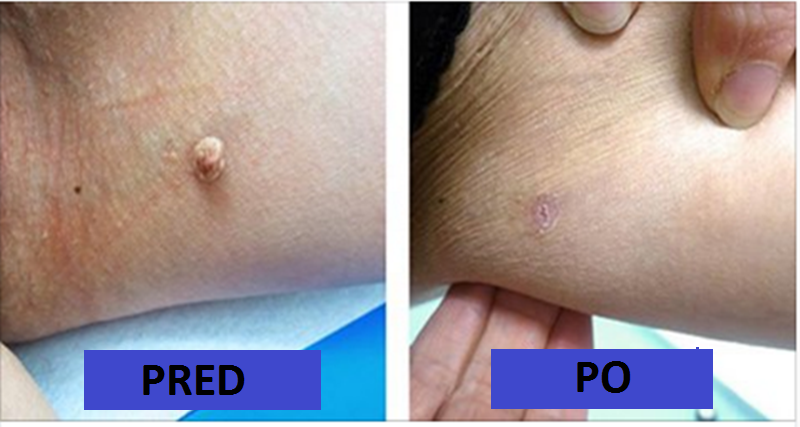 bradaviceRub-THIS-Natural-Ingredient-on-Your-Skin-Tags-and-They-Will-Disappear-in-No-Time