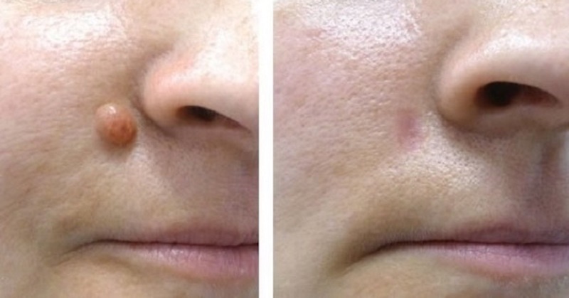bradavicesmall-wart-before-after