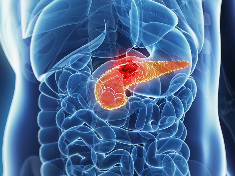 pankreasdt_140626_pancreas_cancer_800x600