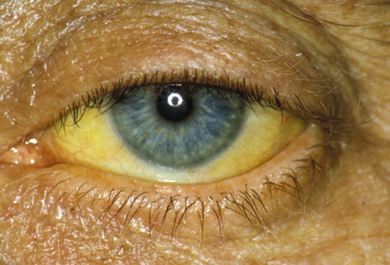 pankreasPRinc_rm_photo_of_jaundiced_eye
